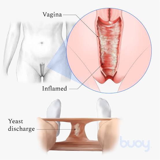 Understanding Yeast Infections: Causes, Symptoms, and Treatment