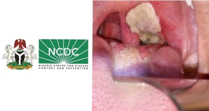 NCDC and a sample diphtheria disease